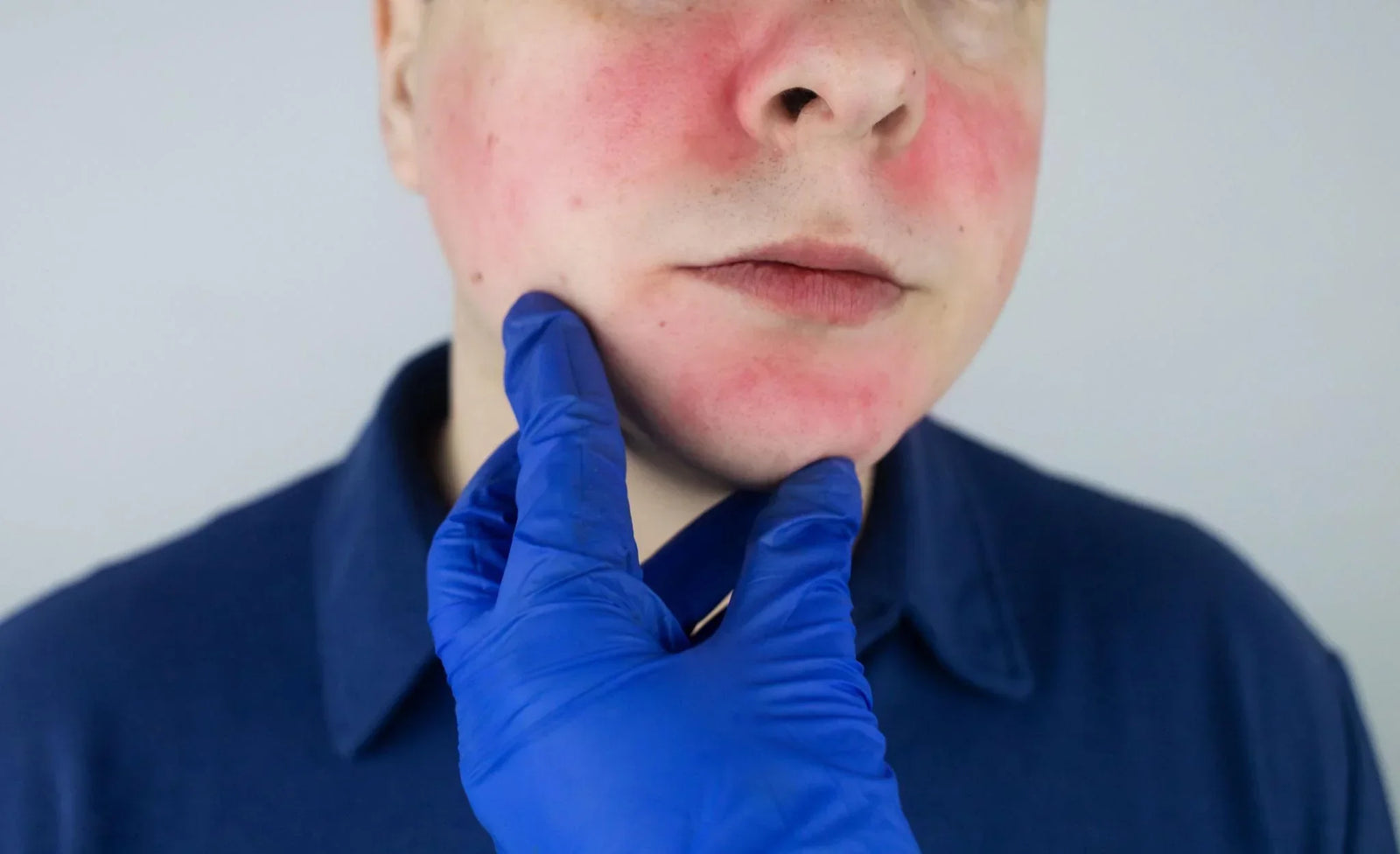 Why It’s Hard to Treat and How Ivermectin Became a Promising Option